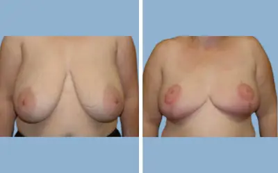 Before and After
